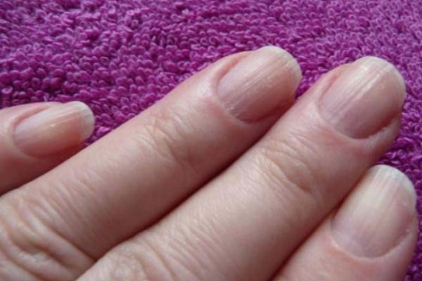 Longitudinal Stripes On Nails